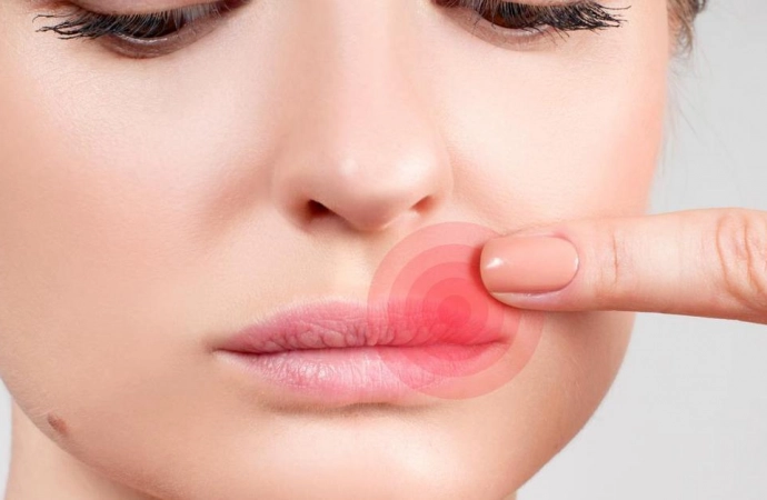 Opryszczka na ustach – jak się jej pozbyć?